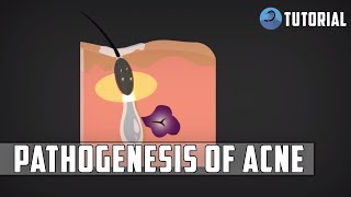 Acne Pathophysiology  Acne Vulgaris Pimples Pathogenesis [upl. by Ellahcim]