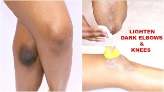 HOW TO LIGHTEN DARK ELBOWS amp KNEES NATURALLY  OMABELLETV [upl. by Inej]