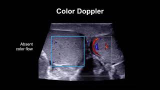 Ultrasound Guided Plantar Fascia Injection [upl. by Cindra125]