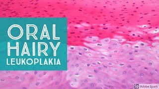 Oral Hairy LeukoplakiaExplained by a Dermatopathologist [upl. by Sena]