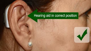 Draining of Massive Ear Hematoma Cauliflower Ear [upl. by Palm]