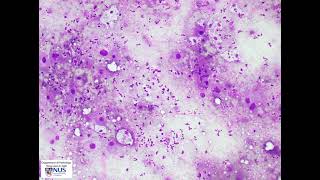 Thyroid cytology  Anaplastic thyroid carcinoma [upl. by Koressa960]