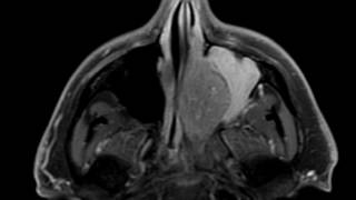 Inverted Papilloma [upl. by Inverson]