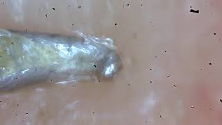 Demodex Facemite removal [upl. by Intihw]