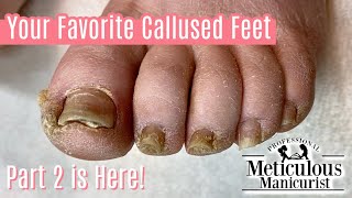 Extremely Callused Feet How to Pedicure  Left Foot [upl. by Dagall]