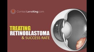 Retinoblastoma Treatment and Eye Cancer Survival Rate [upl. by Gollin]