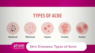 Types of Acne [upl. by Eidissac145]