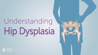 Patient Perspective Congenital hip dysplasia [upl. by Aehsel657]