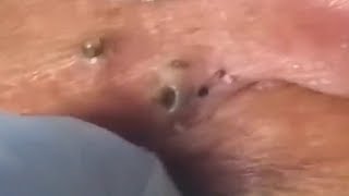 LARGE Blackheads Removal  Satisfying Blackhead 2019 Part 04 [upl. by Tecu372]