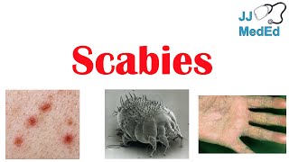 Scabies Skin Condition  What Is It Classic vs Crusted Types Signs amp Symptoms Treatment [upl. by Oilegor]