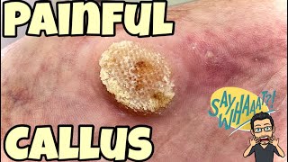 SATISFYING CALLUS REMOVAL FROM FEET [upl. by Patrizius]