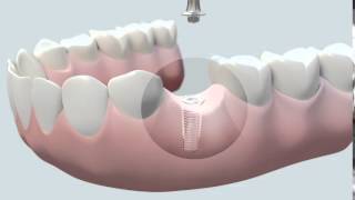 Cómo se coloca un implante dental [upl. by Eizus]