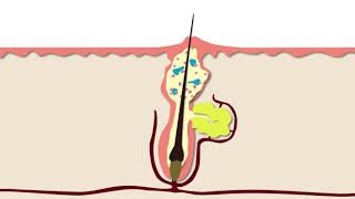 How Acne Develops  Acne Support [upl. by Rannug]