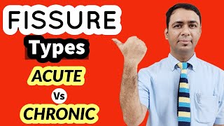 ACUTE FISSURE VS CHRONIC FISSURE  WHAT IS MAIN DIFFERENCE IN TREATMENT OPTIONS [upl. by Hazaki513]