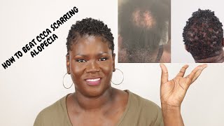 5 things that really work for CCCA or scarring alopecia [upl. by Naujet966]