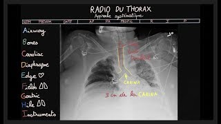 Radio du thorax  ABCDEFGHI  Partie 2  Docteur Synapse [upl. by Imotas474]