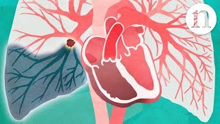 Pulmonary embolism The route to recovery [upl. by Gnep]