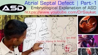 Ventricular Septal Defect normal speed [upl. by Yenial320]