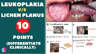 Leukoplakia Vs Lichen planus  Signs of leukoplakia  Signs of lichen planus  Leukoplakia tongue [upl. by Yrdua]