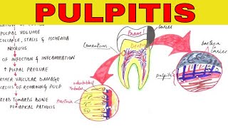 Pulpitis  Pathophysiology Causes amp Types [upl. by Noira432]