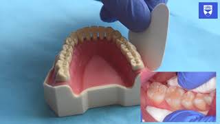 Technique for placing a resin fissure sealant [upl. by Isoj862]