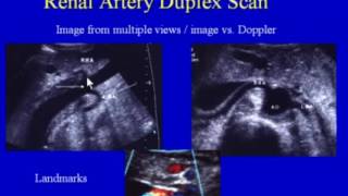 Renal Artery Duplex Scan [upl. by Banky]