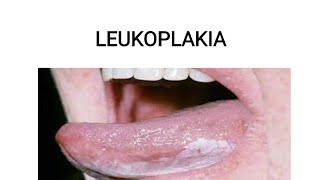 leukoplakia  Easy explanation [upl. by Ecyal]