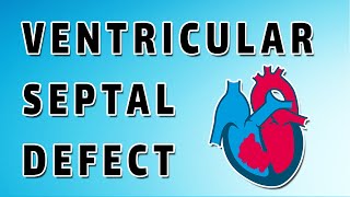 Ventricular Septal Defect [upl. by Elaen]