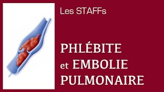 Phlébite et Embolie pulmonaire  12  STAFFs Saint Camille [upl. by Lemahs]