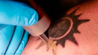 How Laser Tattoo Removal Works  Smarter Every Day 123 [upl. by Nyleimaj]