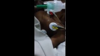 Stridor in a post extubated child [upl. by Sell]