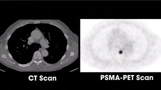 livingwithphca  VQ Lung Scan [upl. by Naujled]