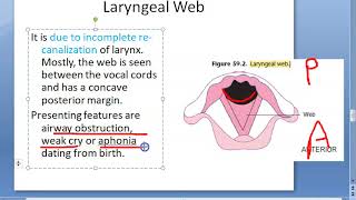 ENT 348 b Laryngeal Web Biphasic stridor [upl. by Lahcsap885]