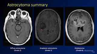 Radiology of Spine Trauma [upl. by Aloisius]