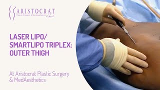 Laser Lipo SmartLipo Triplex Outer Thigh [upl. by Roderick]