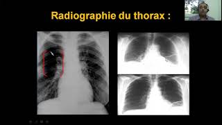 Embolie pulmonaire Dr Khacha Cardio  Quatrième Année Médecine [upl. by Elleirbag]