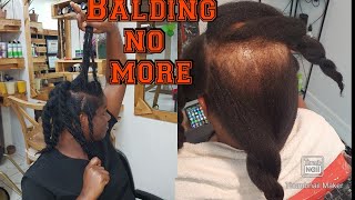 Alopecia update XTC hair boost systemLaser regrowth therapy How to grow back bald patches [upl. by Deena]