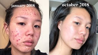 How to Prevent Acne Breakouts [upl. by Nalyr]