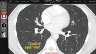 Lobar and Segmental Lung Anatomy on CT [upl. by Lleznod]