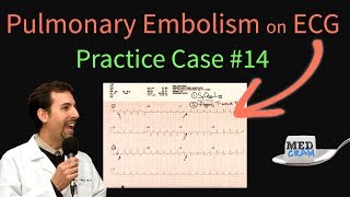 ECG Findings in Pulmonary Embolism  EKG Changes With an Acute PE [upl. by Lopez]