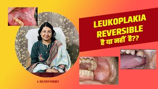 Leukoplakia reversible है या नहीं है [upl. by Kamp]