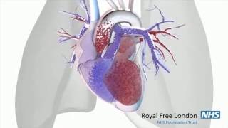 What is pulmonary hypertension [upl. by Intisar]