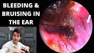 Ear Disorders Pt1 Middle Ear Infection Symptoms amp Otitis Media Causes  Ruptured Eardrum Treatment [upl. by Tychonn]