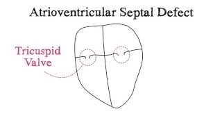 Atrioventricular Septal Defect AVSD [upl. by Llabmik]