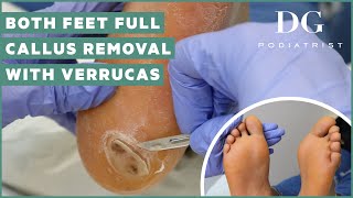 Callus removal from feet both feet and three verruca plantar warts treatment [upl. by Ayatan]