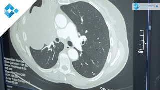 Staging of Lung Cancer [upl. by Ekard]