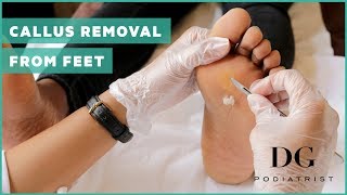 Callus removal from feet balls of feet [upl. by Cud]