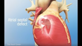 Atrioventricular Septal Defects Ami Bhatt MD [upl. by Doti]