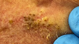 Extremely Clogged Pores Extracted  Contour Dermatology [upl. by Nofets]