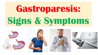 Swallowing Problems or Dysphagia Top 4 Possible Causes Including Cricopharyngeal Dysfunction CPD [upl. by Wahl711]